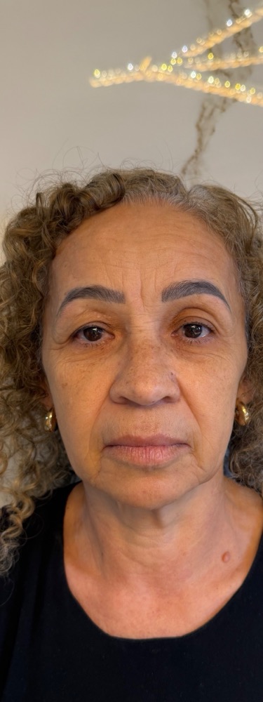 Antes — harmonização facial
