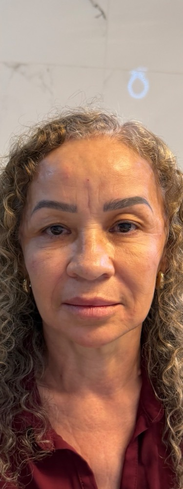 Depois — harmonização facial